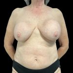Breast Implant Exchange + Enbloc Capsulectomy + Breast Lift Before & After Patient #6554