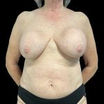Breast Implant Exchange + Enbloc Capsulectomy + Breast Lift Before & After Patient #6554