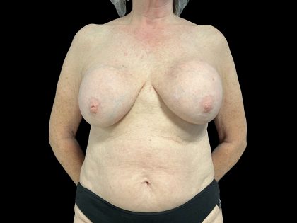 Breast Implant Exchange + Enbloc Capsulectomy + Breast Lift Before & After Patient #6554