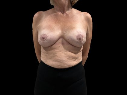 Breast Implant Exchange + Enbloc Capsulectomy + Breast Lift Before & After Patient #6553
