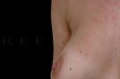 Fat Transfer to Breasts Before & After Patient #6649