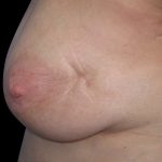 Fat Transfer to Breasts Before & After Patient #6648
