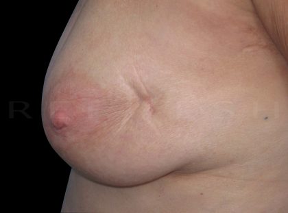 Fat Transfer to Breasts Before & After Patient #6648