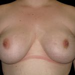 Fat Transfer to Breasts Before & After Patient #6647
