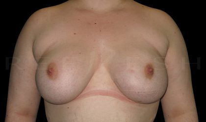 Fat Transfer to Breasts Before & After Patient #6647