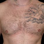 Gynaecomastia Before & After Patient #6737
