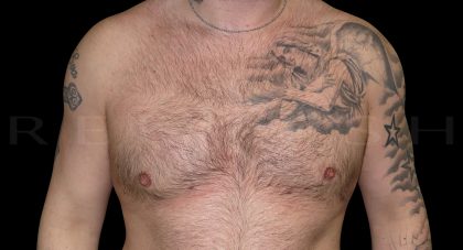 Gynaecomastia Before & After Patient #6737