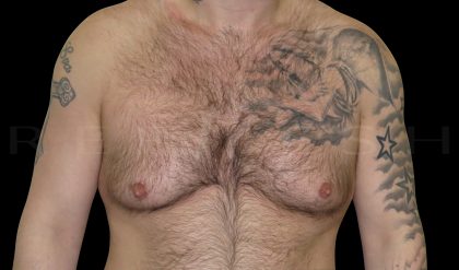 Gynaecomastia Before & After Patient #6737