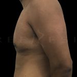 Gynaecomastia Before & After Patient #6728