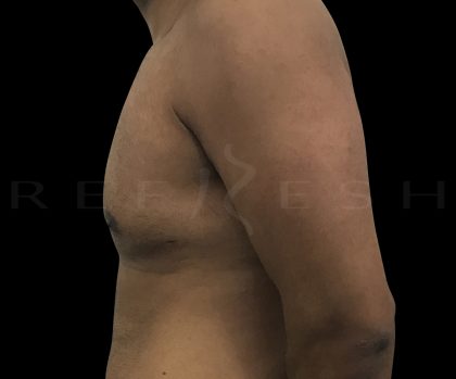 Gynaecomastia Before & After Patient #6728