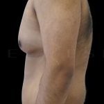 Gynaecomastia Before & After Patient #6728