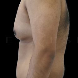 Gynaecomastia Before & After Patient #6728