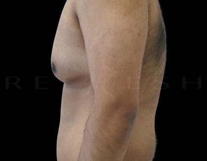 Gynaecomastia Before & After Patient #6728