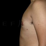 Gynaecomastia Before & After Patient #6727