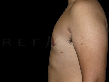 Gynaecomastia Before & After Patient #6727