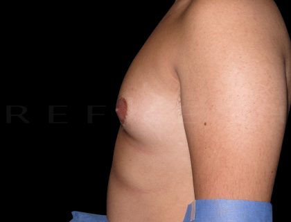 Gynaecomastia Before & After Patient #6727