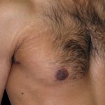 Gynaecomastia Before & After Patient #6726