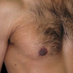 Gynaecomastia Before & After Patient #6726