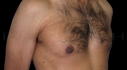 Gynaecomastia Before & After Patient #6726