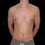 Gynaecomastia Before & After Patient #6725