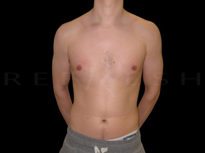 Gynaecomastia Before & After Patient #6725