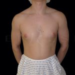 Gynaecomastia Before & After Patient #6725