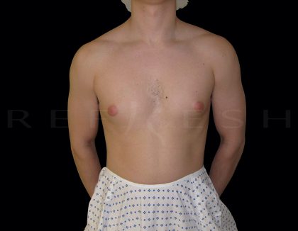 Gynaecomastia Before & After Patient #6725