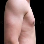 Gynaecomastia Before & After Patient #6724