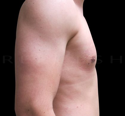 Gynaecomastia Before & After Patient #6724