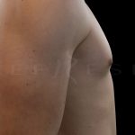 Gynaecomastia Before & After Patient #6724