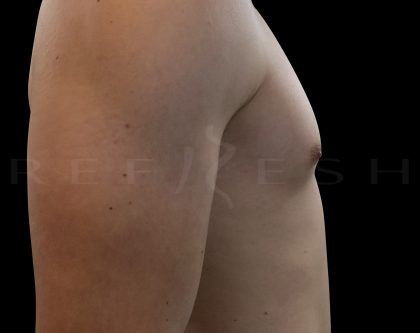 Gynaecomastia Before & After Patient #6724