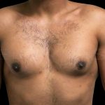 Gynaecomastia Before & After Patient #6723