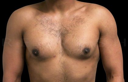 Gynaecomastia Before & After Patient #6723