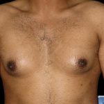 Gynaecomastia Before & After Patient #6723