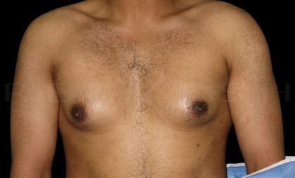 Gynaecomastia Before & After Patient #6723