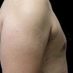 Gynaecomastia Before & After Patient #6736