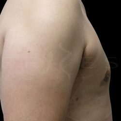 Gynaecomastia Before & After Patient #6736