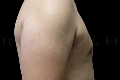 Gynaecomastia Before & After Patient #6736