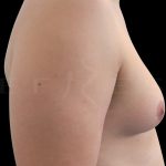 Gynaecomastia Before & After Patient #6736