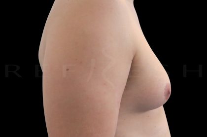 Gynaecomastia Before & After Patient #6736