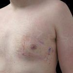 Gynaecomastia Before & After Patient #6735