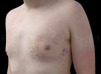 Gynaecomastia Before & After Patient #6735