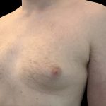 Gynaecomastia Before & After Patient #6735