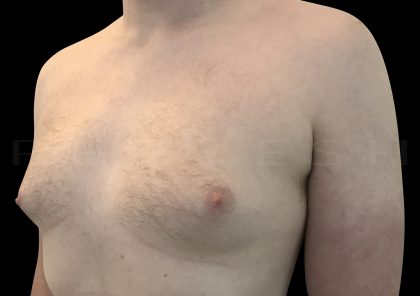 Gynaecomastia Before & After Patient #6735