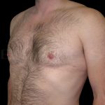 Gynaecomastia Before & After Patient #6734