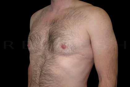 Gynaecomastia Before & After Patient #6734