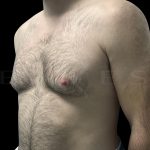 Gynaecomastia Before & After Patient #6734