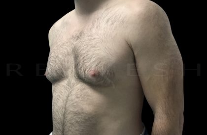 Gynaecomastia Before & After Patient #6734