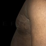 Gynaecomastia Before & After Patient #6733