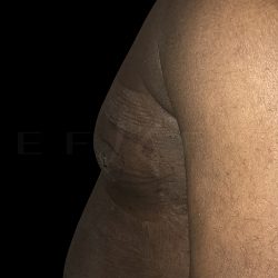 Gynaecomastia Before & After Patient #6733